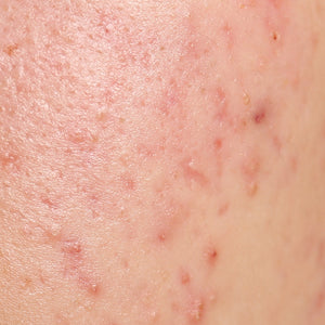 Best Moisturizer For Acne-Prone Skin