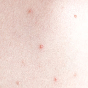 Back Acne & Blemishes