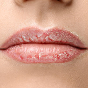 Cracked Lips Remedies