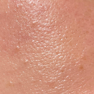 Excess Oil & Sebum Control