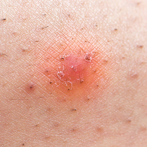 Ingrown Hair & Razor Bumps