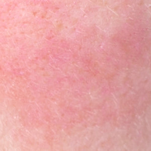 Redness & Sensitive Skin
