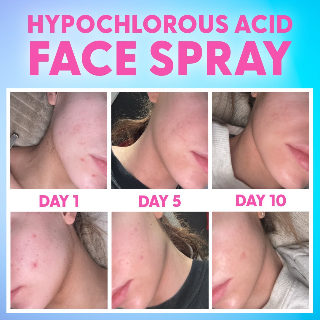 Hypochlorous Acid Face Spray - Give Me Cosmetics